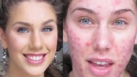 acne-makeup-tutorial-dailymotion-16_2 Acne make-up tutorial dailymotion