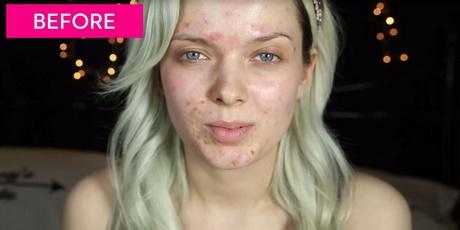flawless-skin-makeup-tutorial-acne-02 Perfecte huid make-up les acne