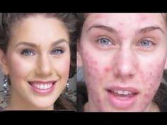 flawless-skin-makeup-tutorial-acne-02_8 Perfecte huid make-up les acne