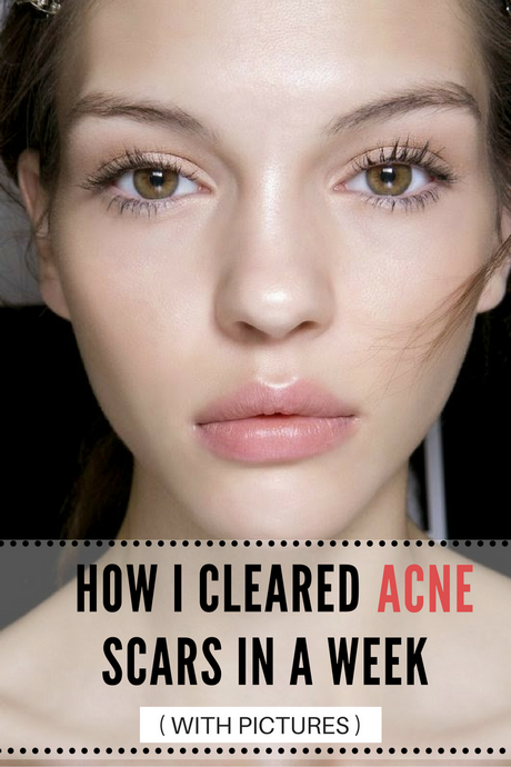 makeup-tutorial-for-acne-scars-14 Make - up tutorial voor acne littekens