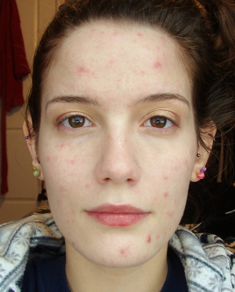 everyday-makeup-tutorial-acne-02_10 Dagelijkse make-up tutorial acne