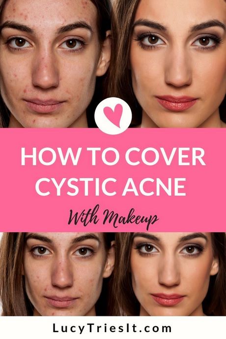 everyday-makeup-tutorial-acne-02_5 Dagelijkse make-up tutorial acne
