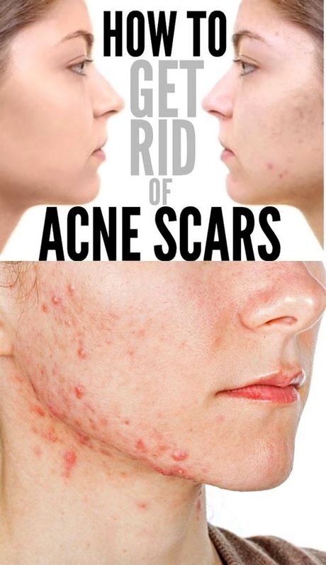 acne-makeup-tips-31_14 Acne make-up tips