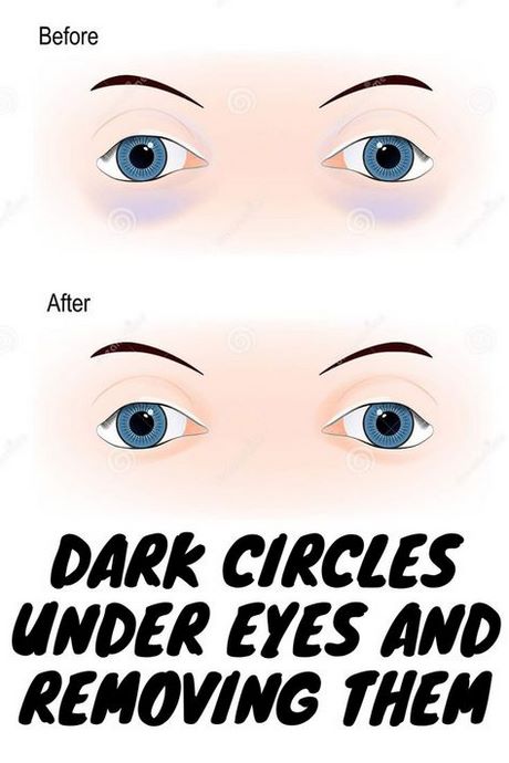 makeup-tips-for-dark-circles-under-eyes-41_2 Make-up tips voor donkere cirkels onder ogen