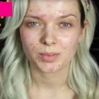 Perfecte huid make-up les acne