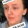 Dagelijkse make-up tutorial acne